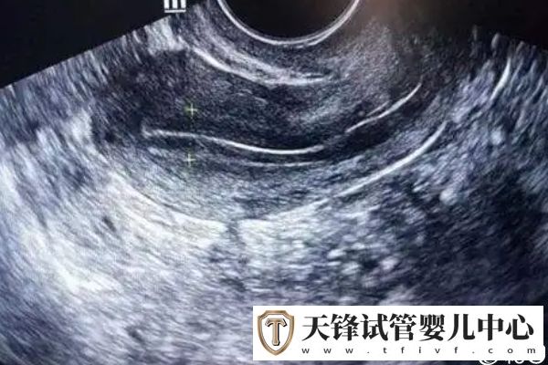 宫内环境异常会导致生化妊娠